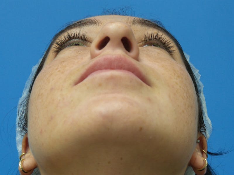 Rhinoplasty Before & After Gallery - Patient 119011 - Image 7