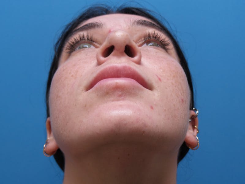 Rhinoplasty Before & After Gallery - Patient 119011 - Image 8