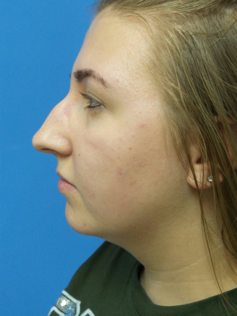 Rhinoplasty Before & After Gallery - Patient 191759 - Image 1