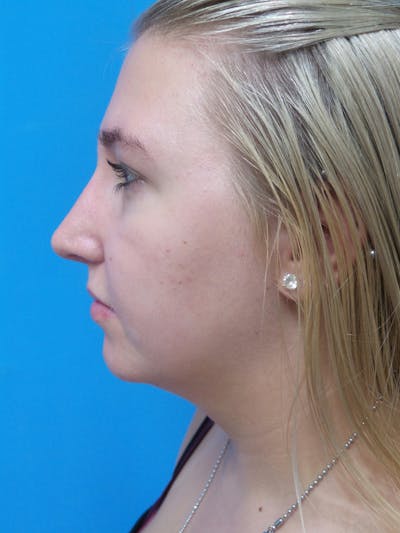 Rhinoplasty Before & After Gallery - Patient 191759 - Image 2