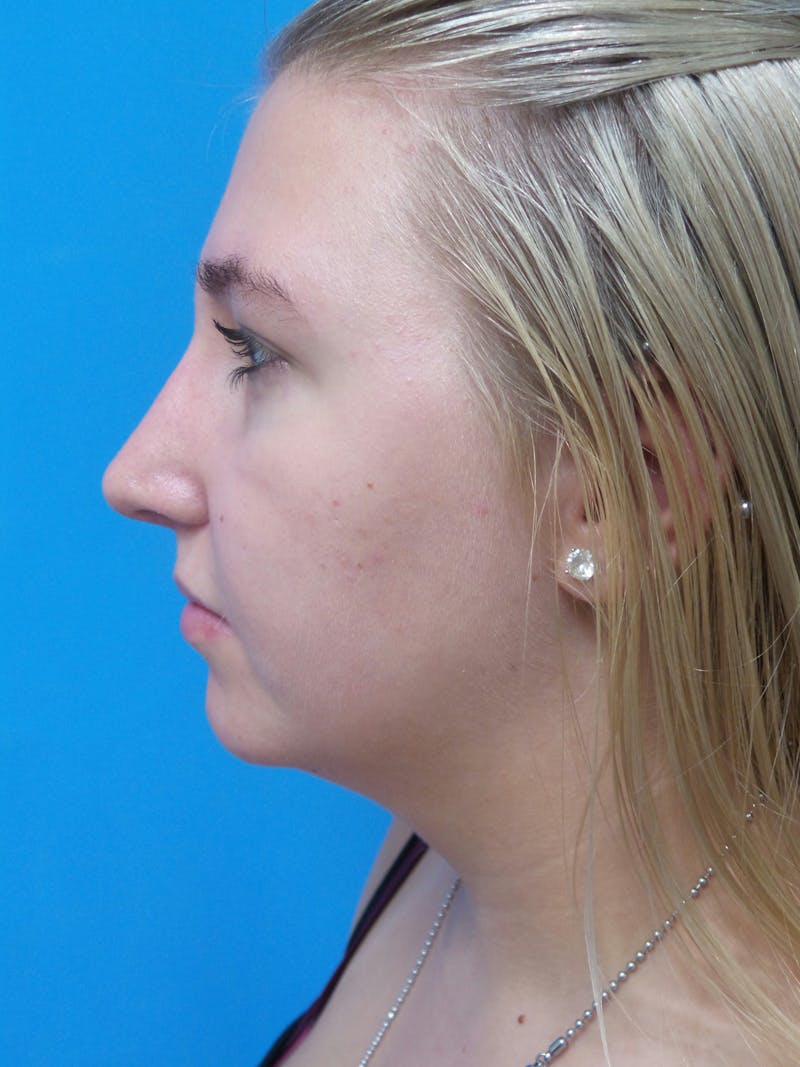 Rhinoplasty Before & After Gallery - Patient 191759 - Image 2