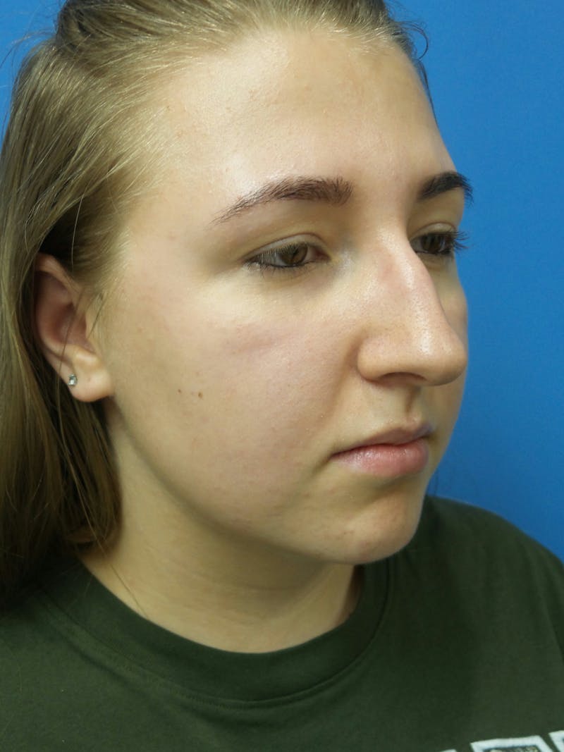 Rhinoplasty Before & After Gallery - Patient 191759 - Image 3