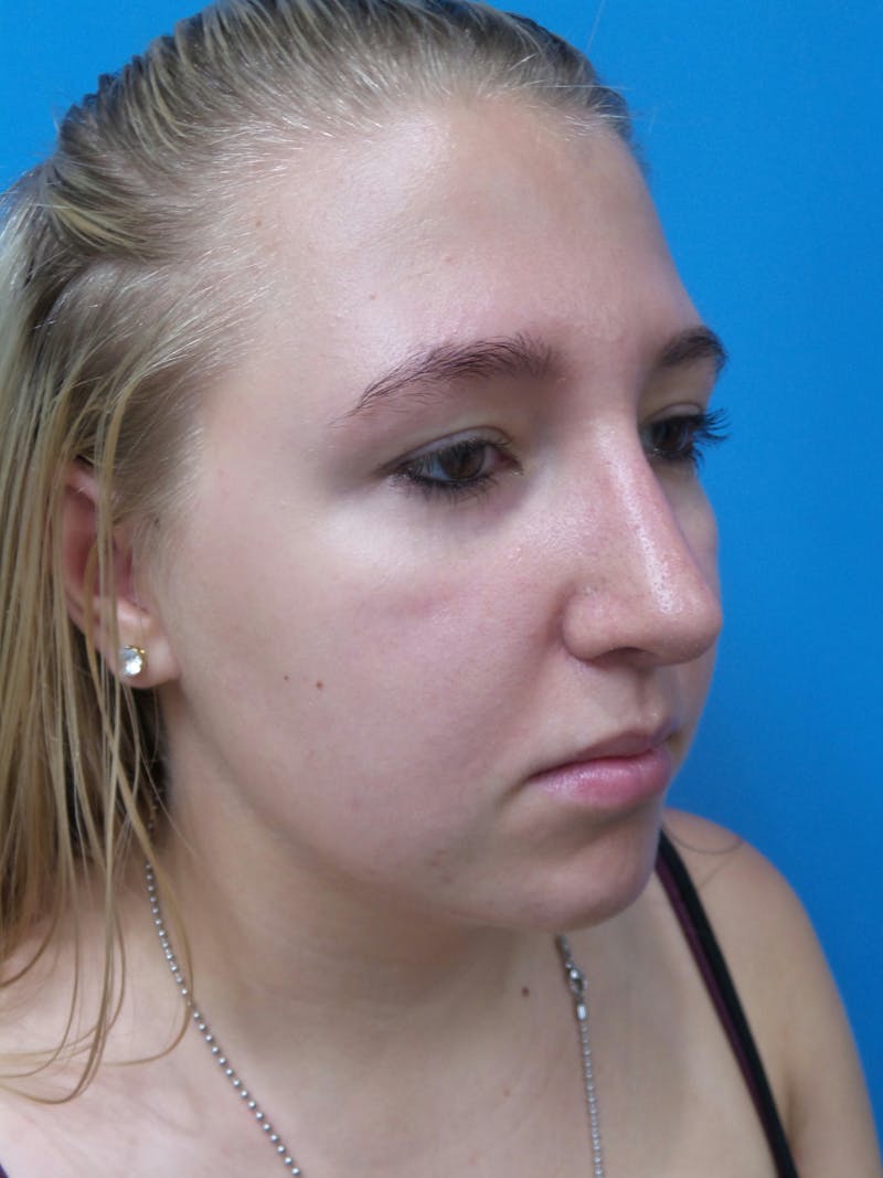 Rhinoplasty Before & After Gallery - Patient 191759 - Image 4