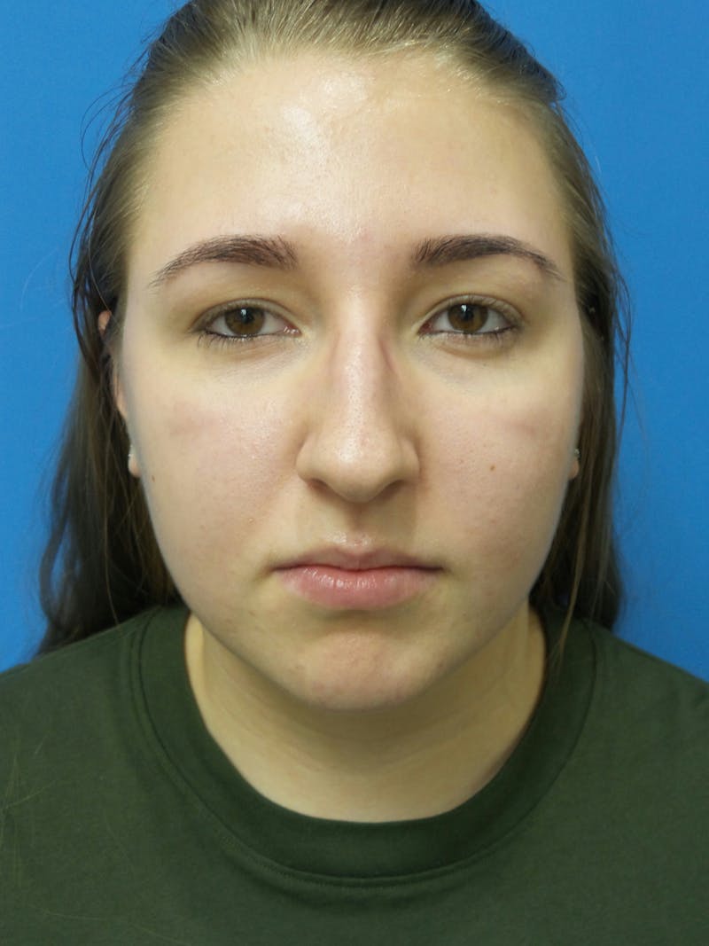 Rhinoplasty Before & After Gallery - Patient 191759 - Image 5