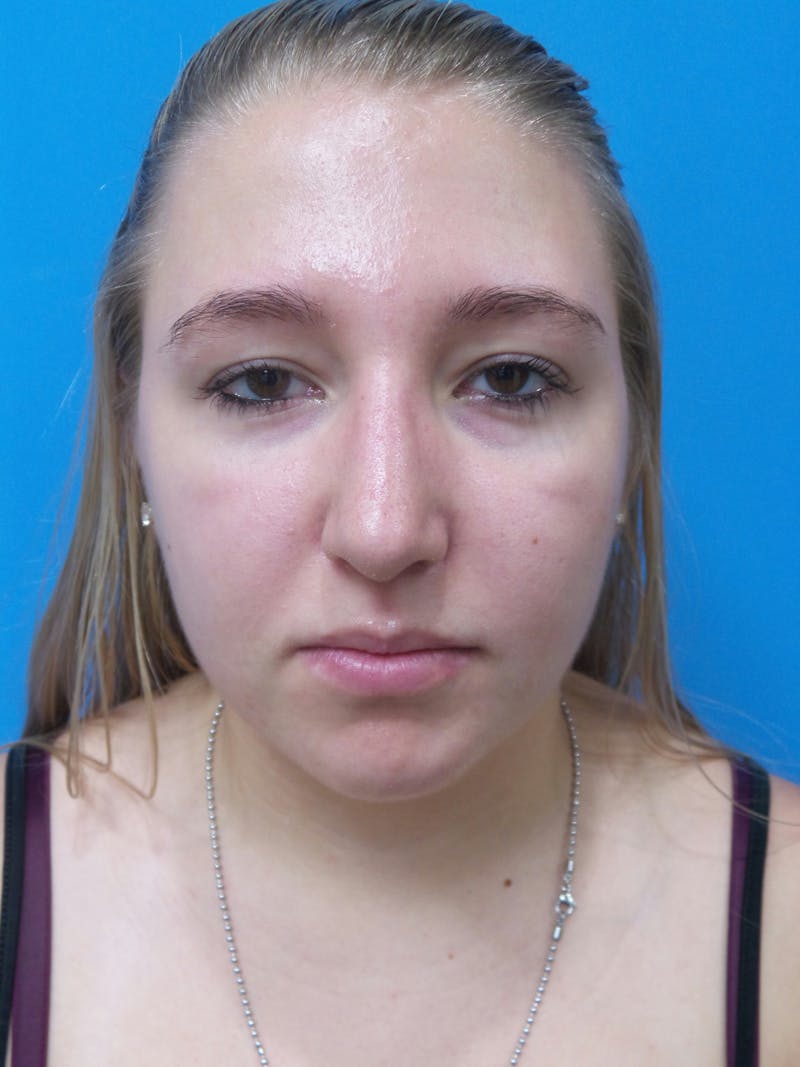 Rhinoplasty Before & After Gallery - Patient 191759 - Image 6