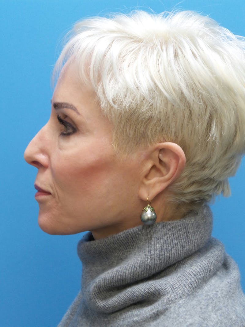 Rhinoplasty Before & After Gallery - Patient 357068 - Image 1
