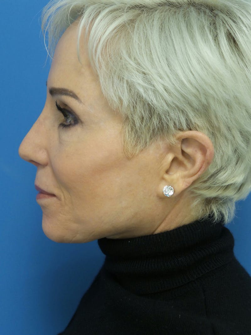Rhinoplasty Before & After Gallery - Patient 357068 - Image 2