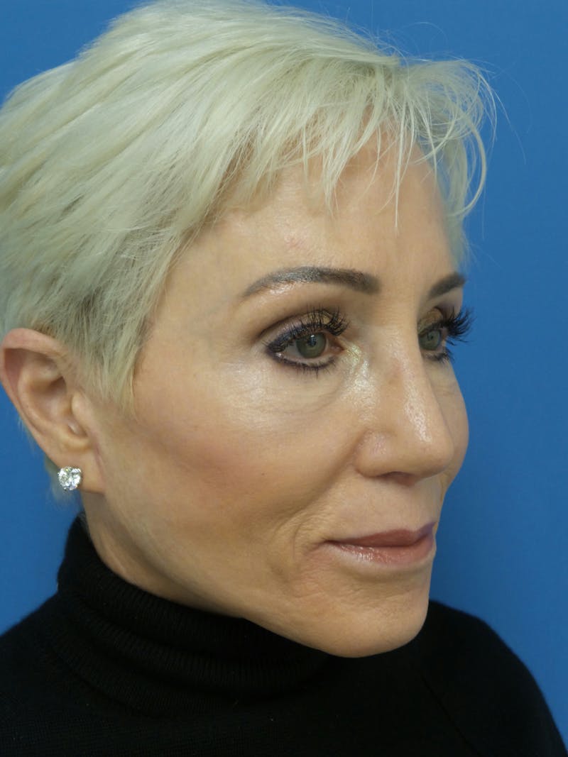 Rhinoplasty Before & After Gallery - Patient 357068 - Image 4