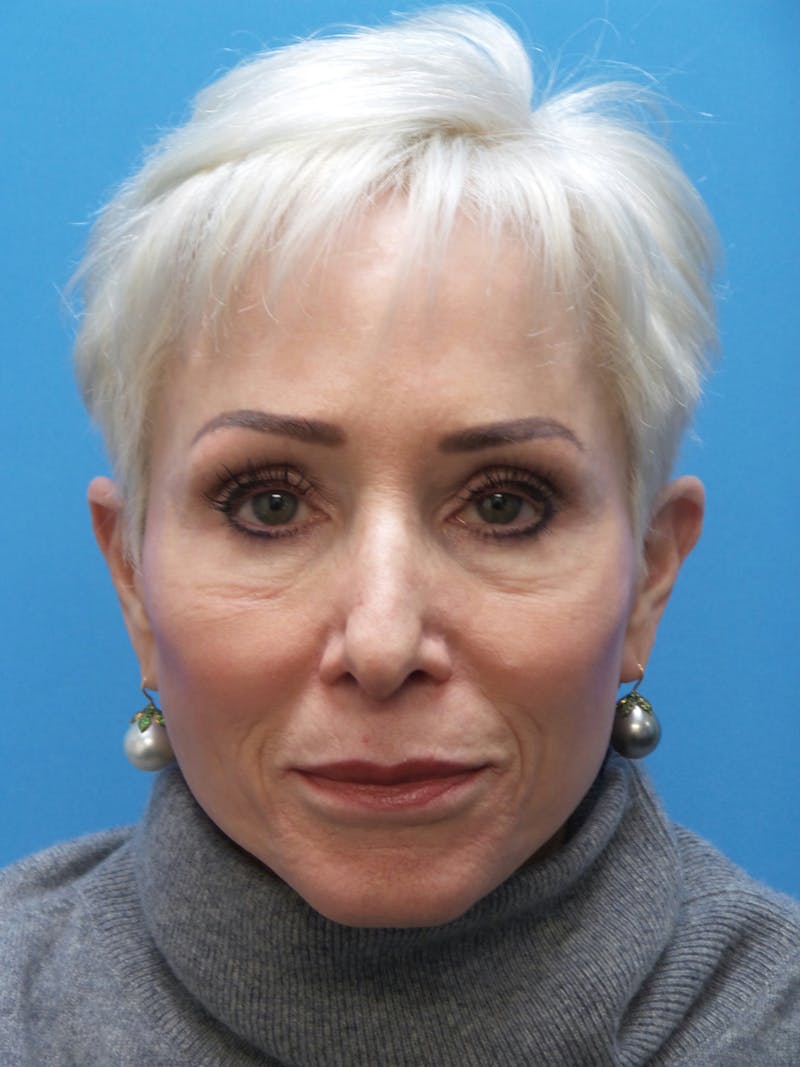 Rhinoplasty Before & After Gallery - Patient 357068 - Image 5