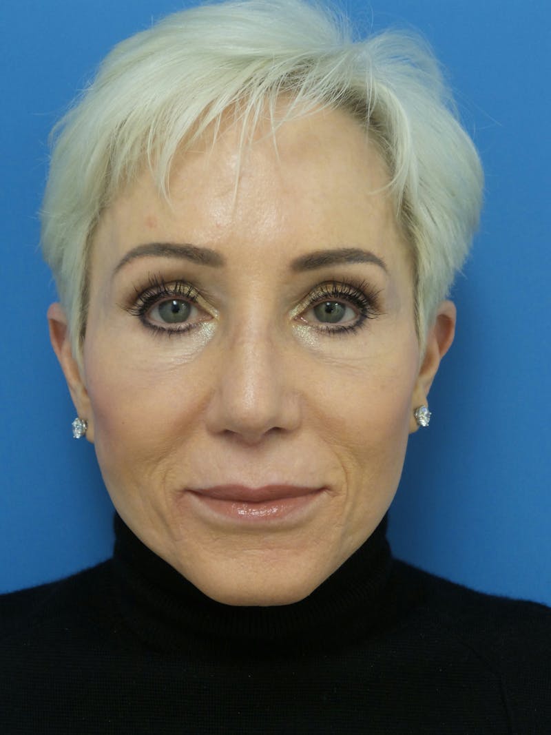 Rhinoplasty Before & After Gallery - Patient 357068 - Image 6