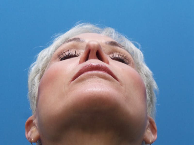 Rhinoplasty Before & After Gallery - Patient 357068 - Image 7