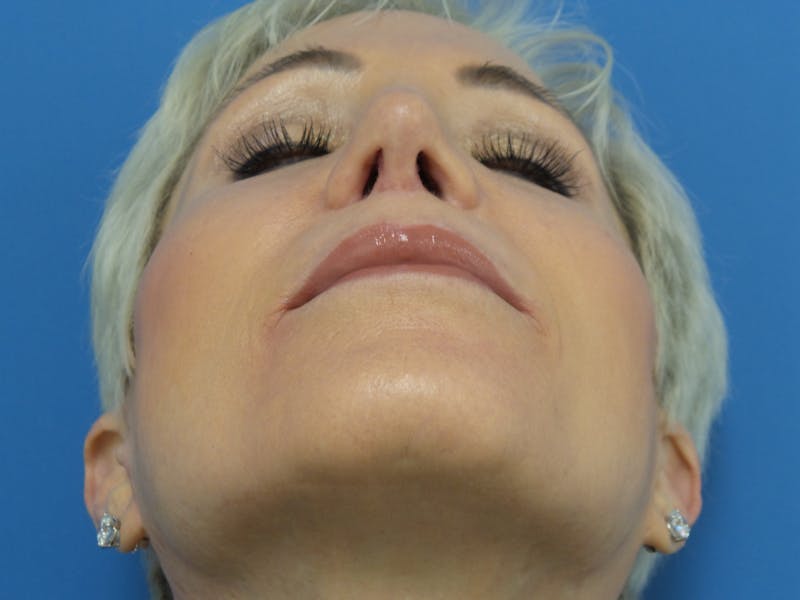 Rhinoplasty Before & After Gallery - Patient 357068 - Image 8