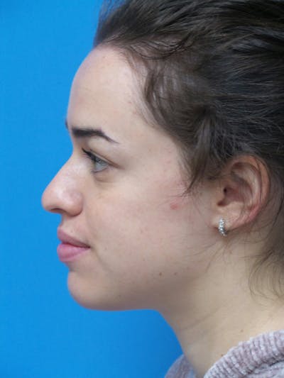 Rhinoplasty Before & After Gallery - Patient 288461 - Image 1