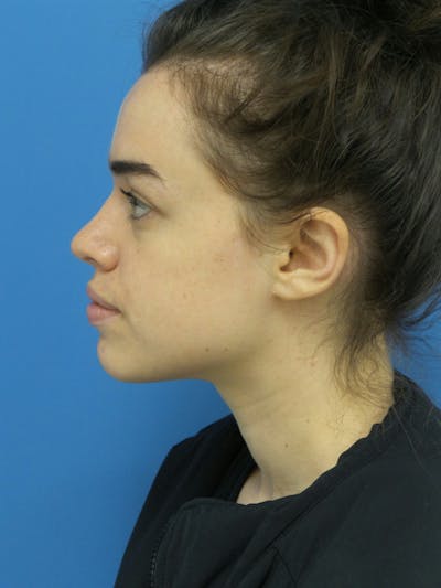 Rhinoplasty Before & After Gallery - Patient 288461 - Image 2