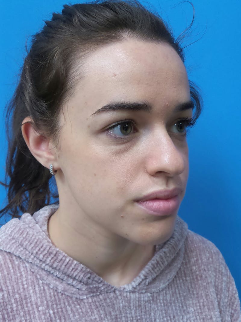 Rhinoplasty Before & After Gallery - Patient 288461 - Image 3