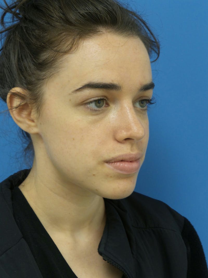 Rhinoplasty Before & After Gallery - Patient 288461 - Image 4