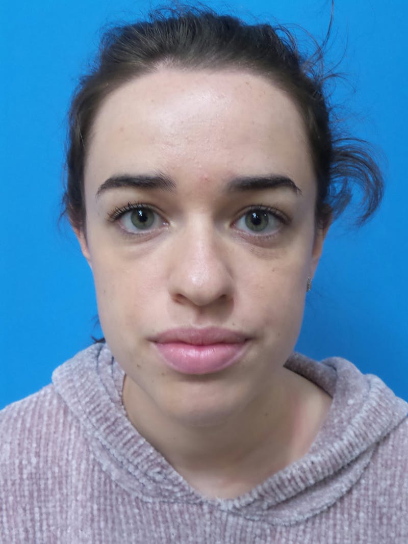 Rhinoplasty Before & After Gallery - Patient 288461 - Image 5