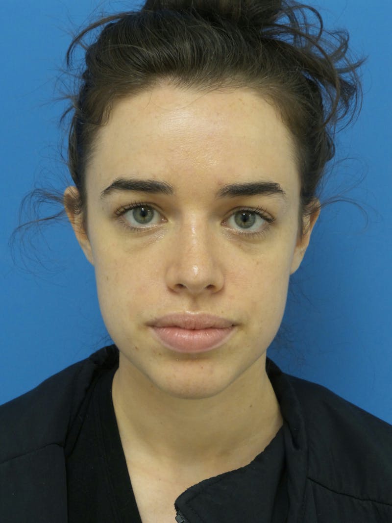 Rhinoplasty Before & After Gallery - Patient 288461 - Image 6