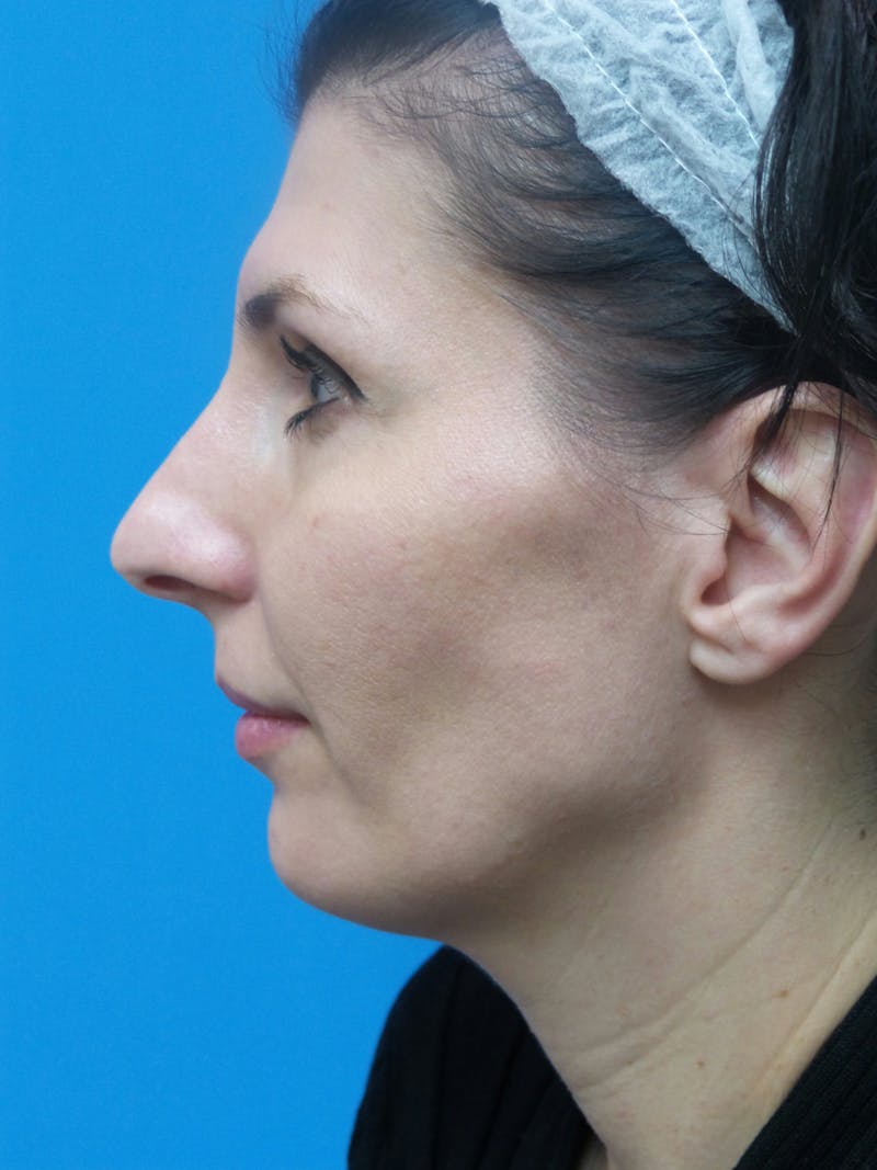 Rhinoplasty Before & After Gallery - Patient 286218 - Image 1