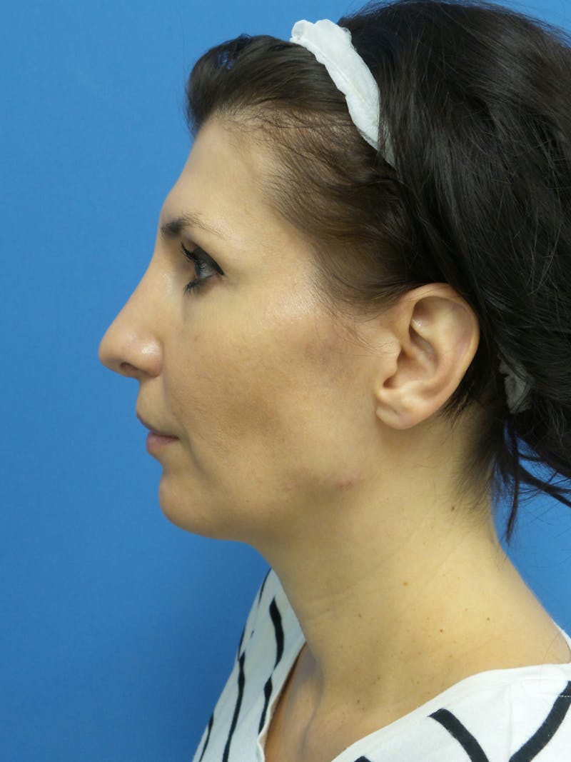 Rhinoplasty Before & After Gallery - Patient 286218 - Image 2