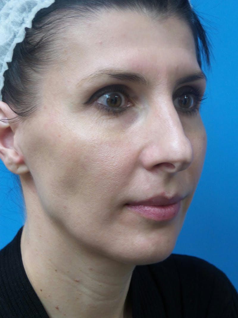 Rhinoplasty Before & After Gallery - Patient 286218 - Image 3