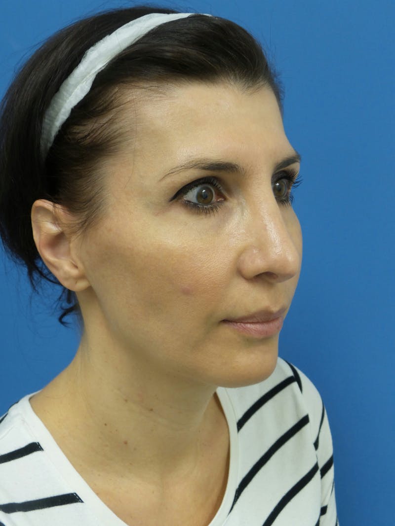 Rhinoplasty Before & After Gallery - Patient 286218 - Image 4