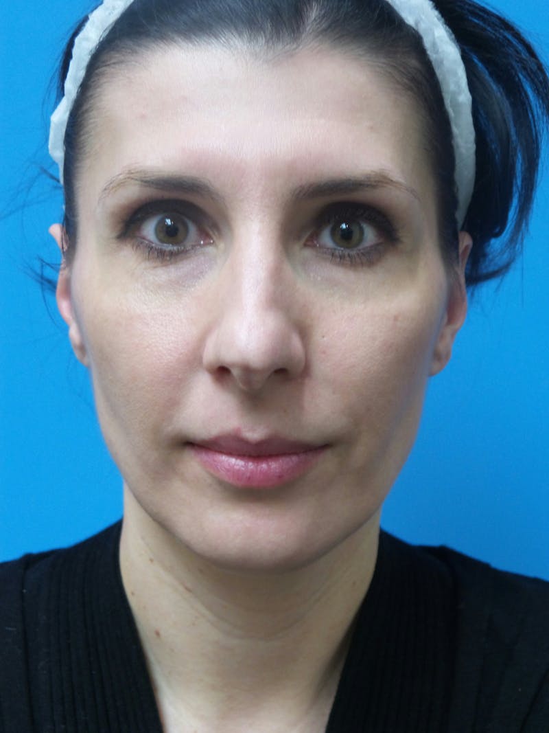Rhinoplasty Before & After Gallery - Patient 286218 - Image 5