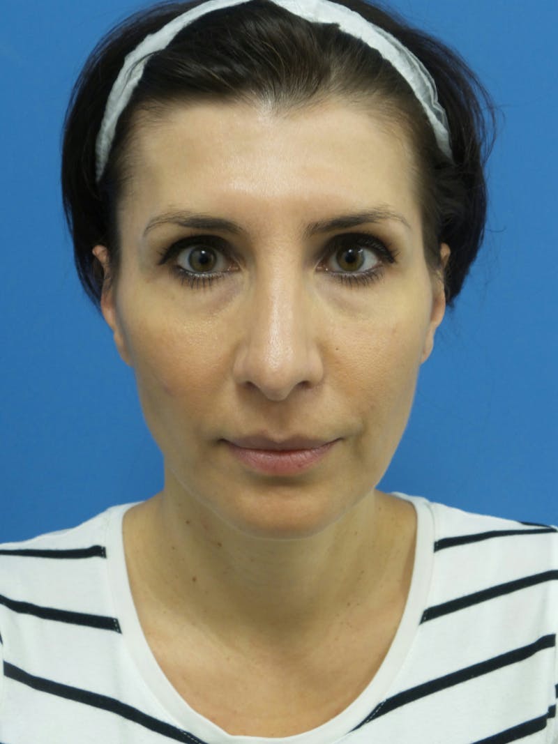 Rhinoplasty Before & After Gallery - Patient 286218 - Image 6