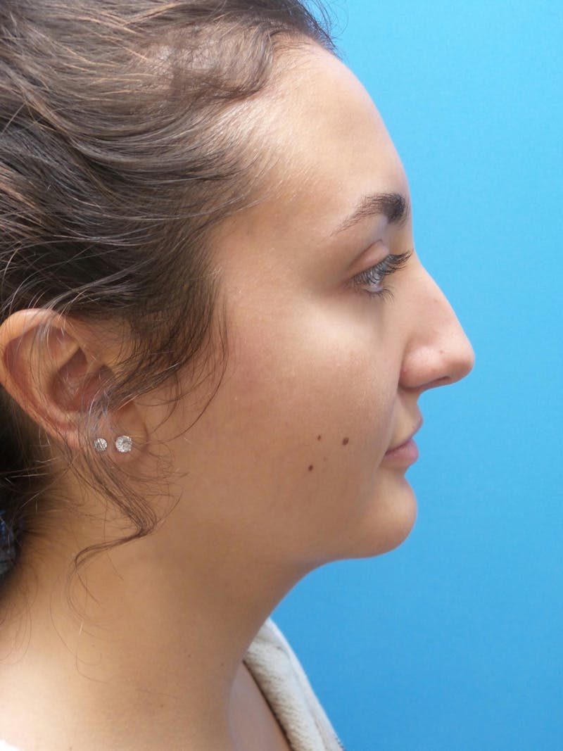 Rhinoplasty Before & After Gallery - Patient 326337 - Image 1
