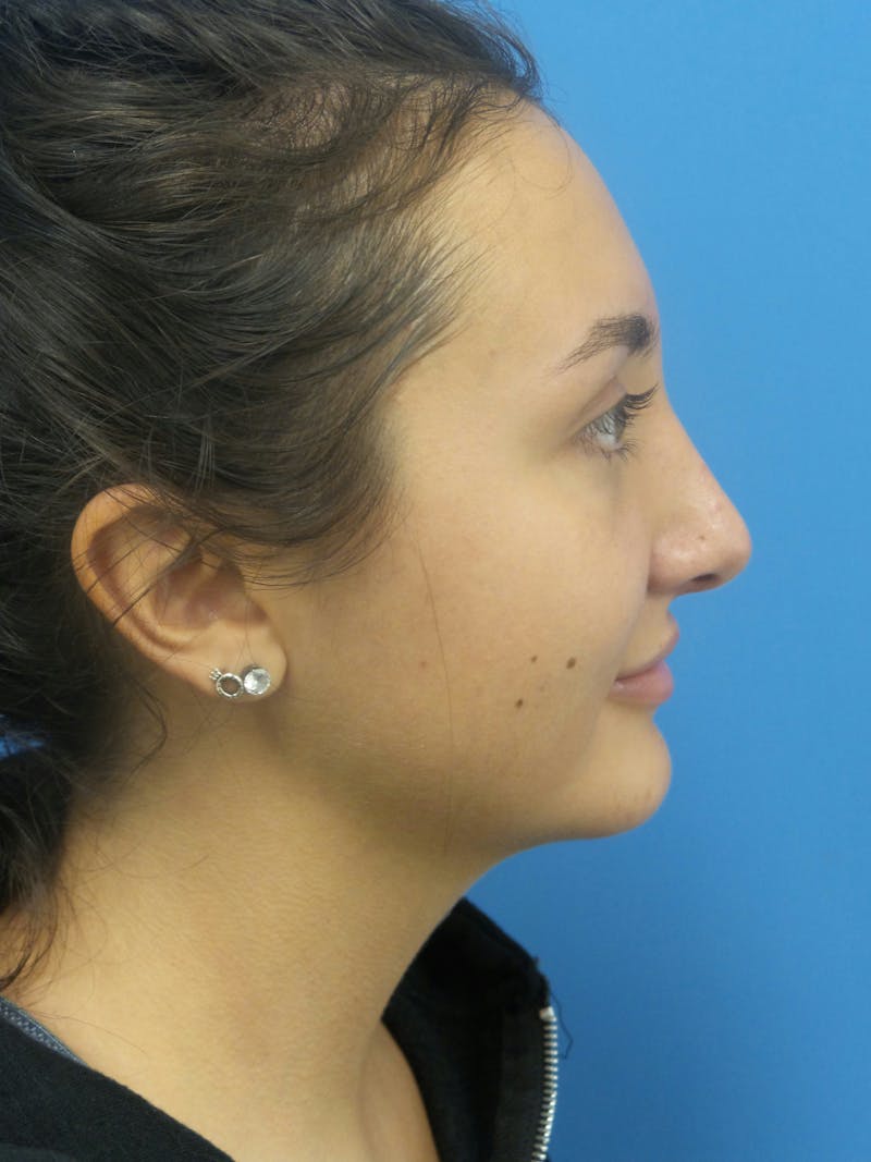 Rhinoplasty Before & After Gallery - Patient 326337 - Image 2