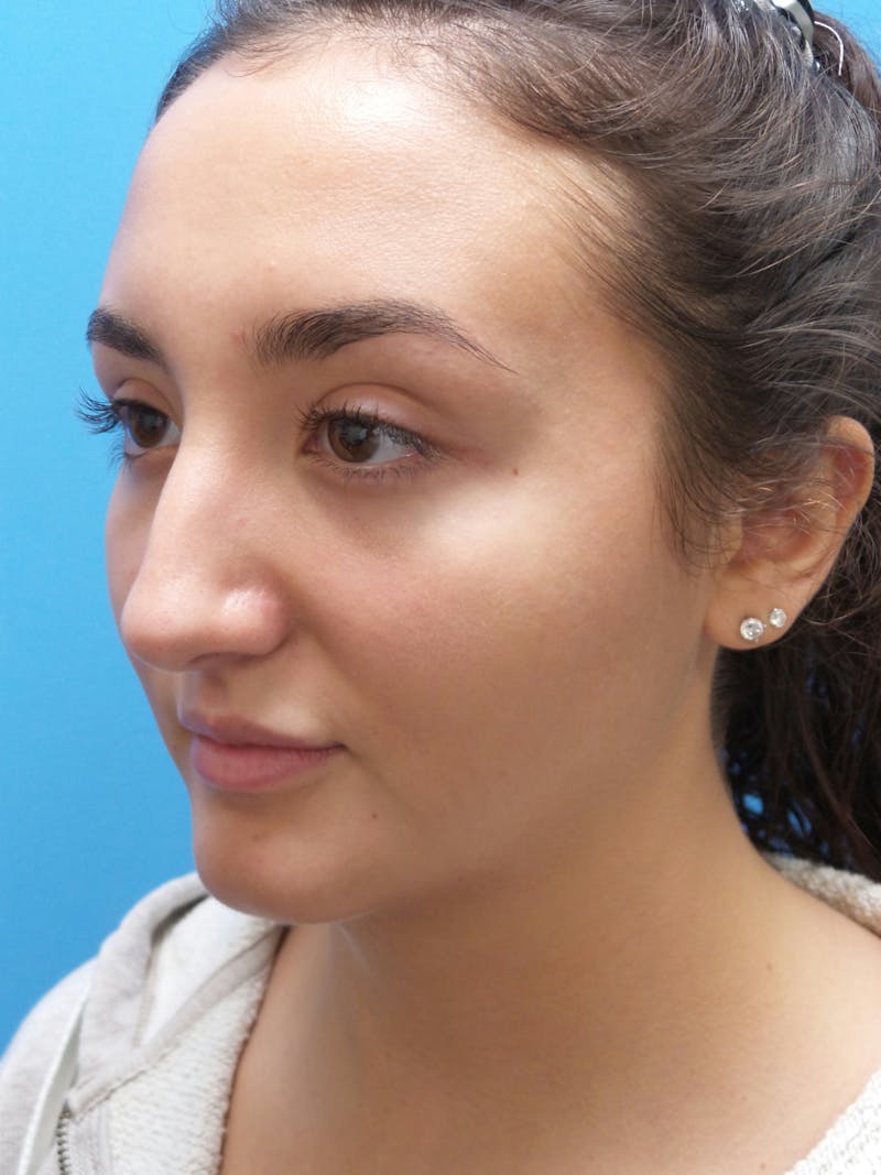 Rhinoplasty Before & After Gallery - Patient 326337 - Image 3