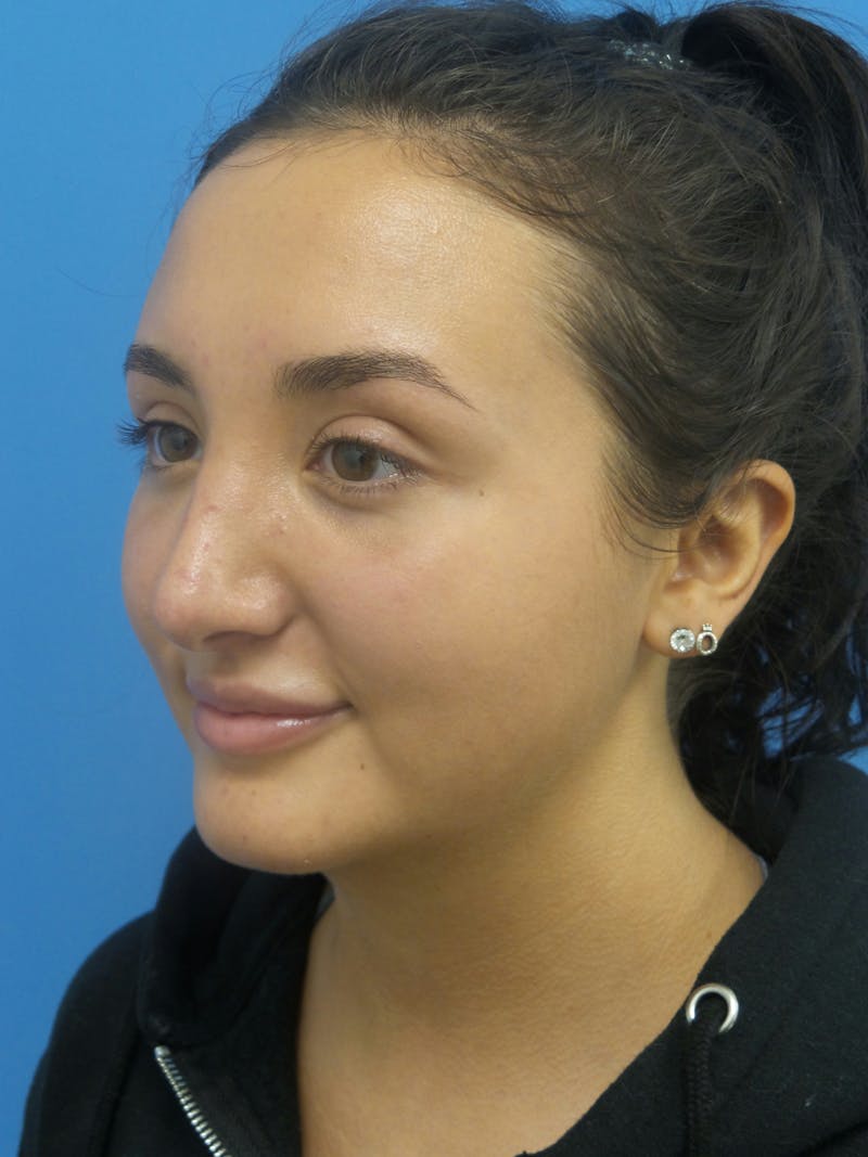 Rhinoplasty Before & After Gallery - Patient 326337 - Image 4