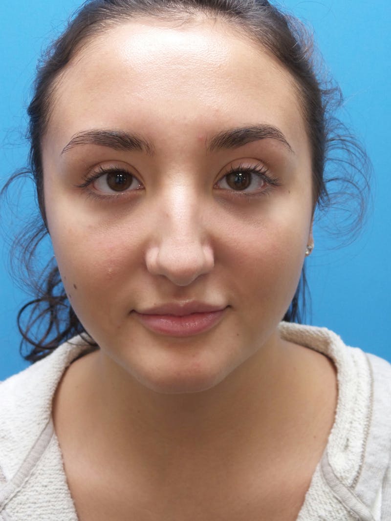 Rhinoplasty Before & After Gallery - Patient 326337 - Image 5