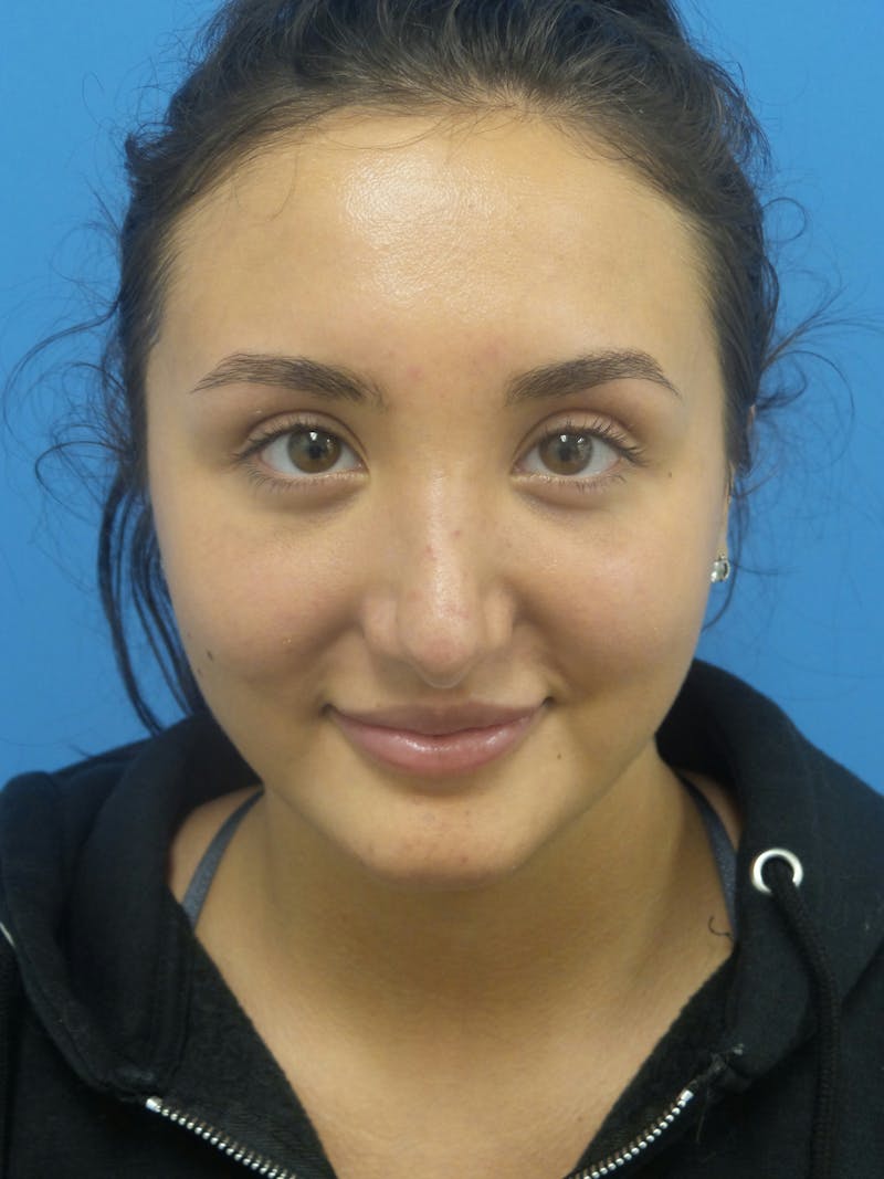Rhinoplasty Before & After Gallery - Patient 326337 - Image 6