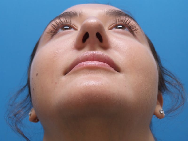 Rhinoplasty Before & After Gallery - Patient 326337 - Image 7