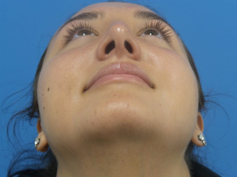 Rhinoplasty Before & After Gallery - Patient 326337 - Image 8