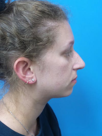 Rhinoplasty Before & After Gallery - Patient 941238 - Image 1