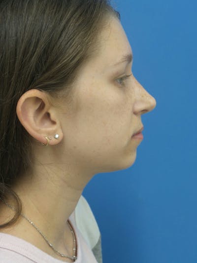 Rhinoplasty Before & After Gallery - Patient 941238 - Image 2