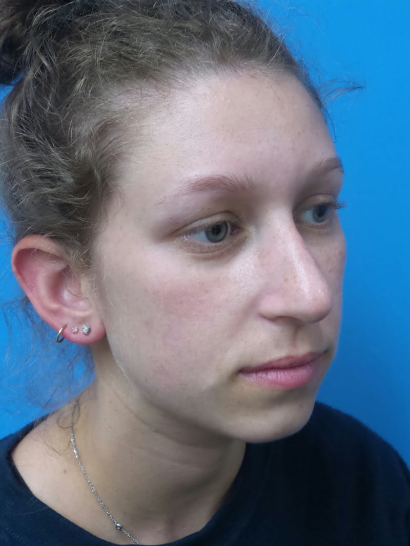 Rhinoplasty Before & After Gallery - Patient 941238 - Image 3