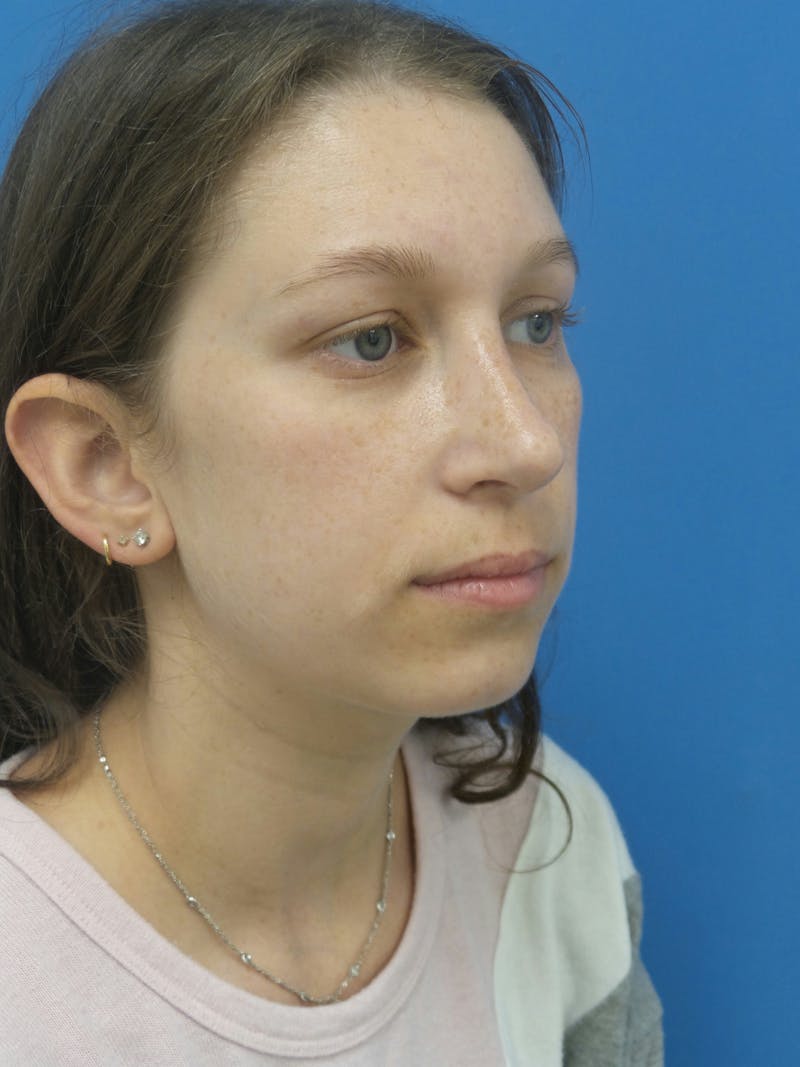 Rhinoplasty Before & After Gallery - Patient 941238 - Image 4