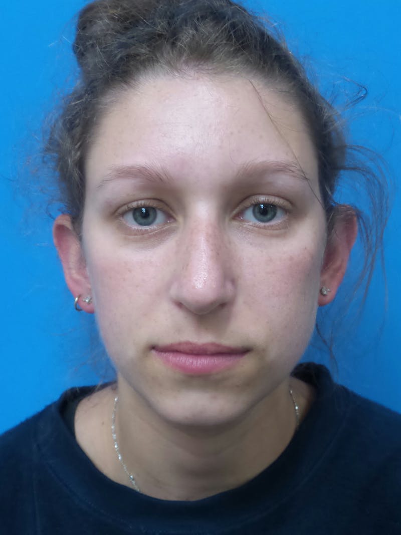 Rhinoplasty Before & After Gallery - Patient 941238 - Image 5