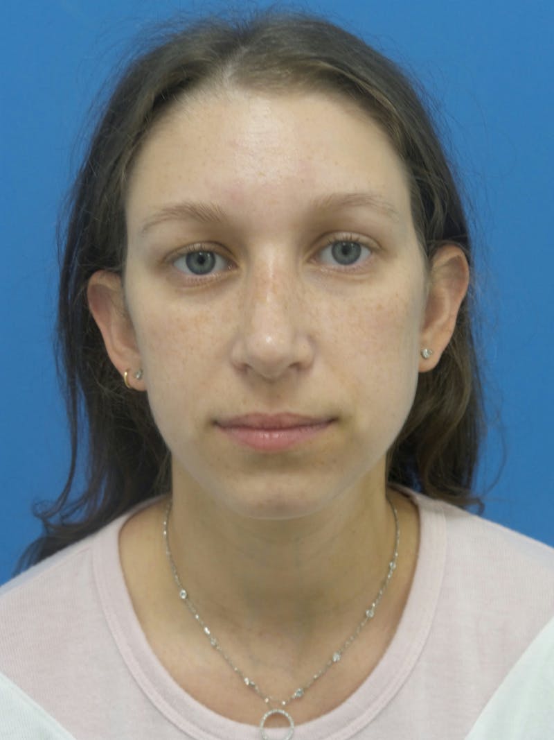 Rhinoplasty Before & After Gallery - Patient 941238 - Image 6