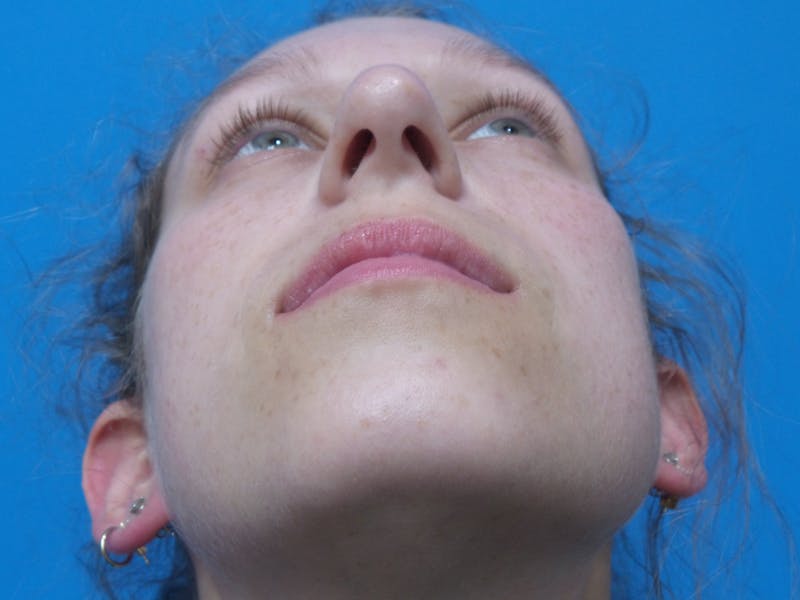 Rhinoplasty Before & After Gallery - Patient 941238 - Image 7