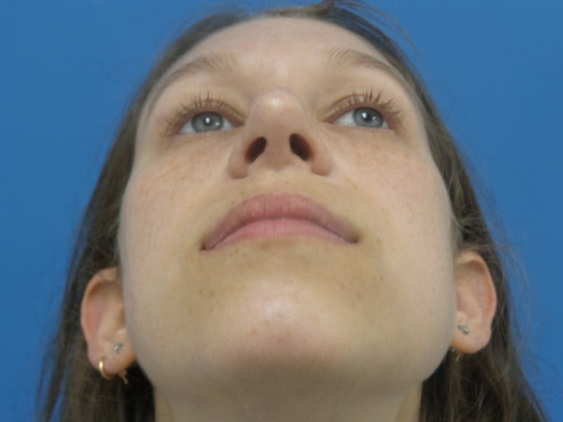 Rhinoplasty Before & After Gallery - Patient 941238 - Image 8