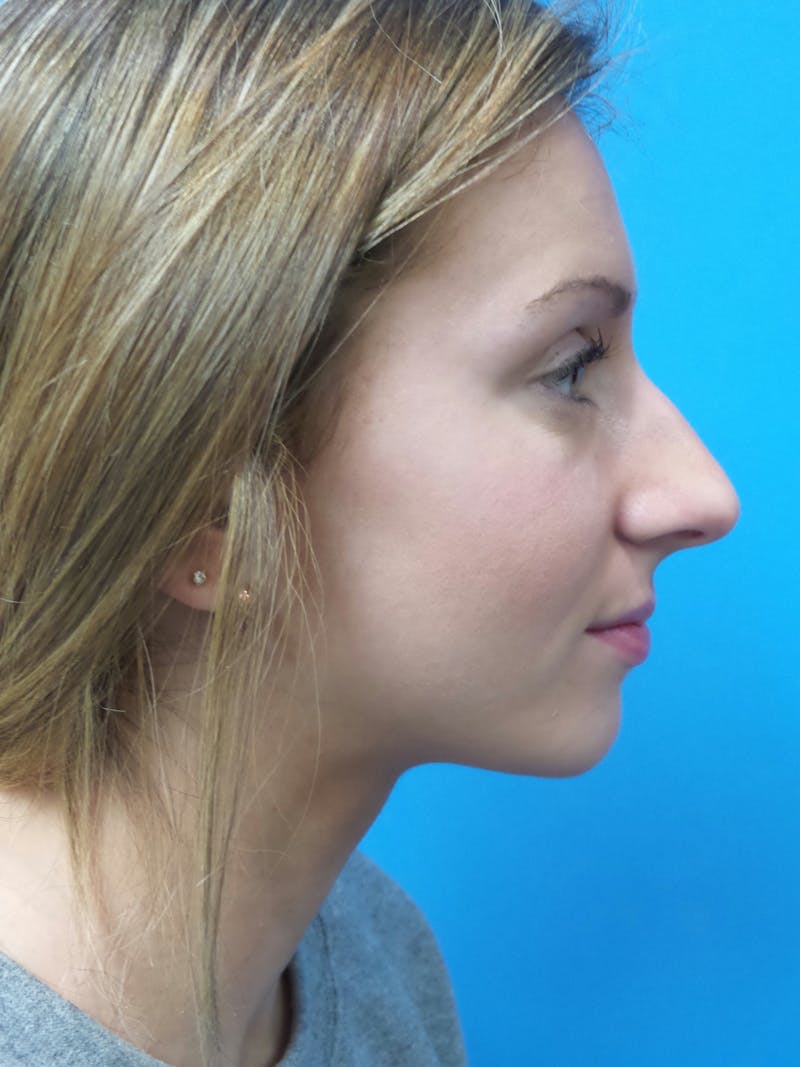 Rhinoplasty Before & After Gallery - Patient 630550 - Image 1