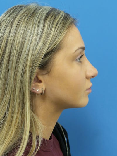 Rhinoplasty Before & After Gallery - Patient 630550 - Image 2