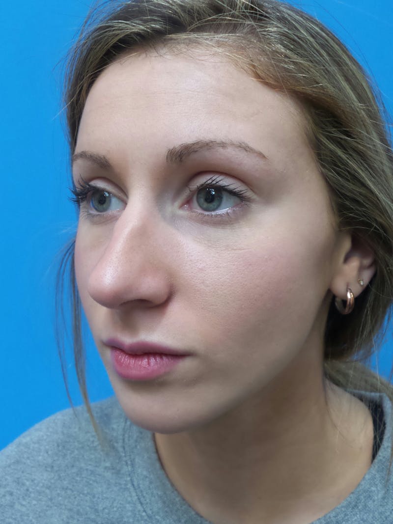 Rhinoplasty Before & After Gallery - Patient 630550 - Image 3
