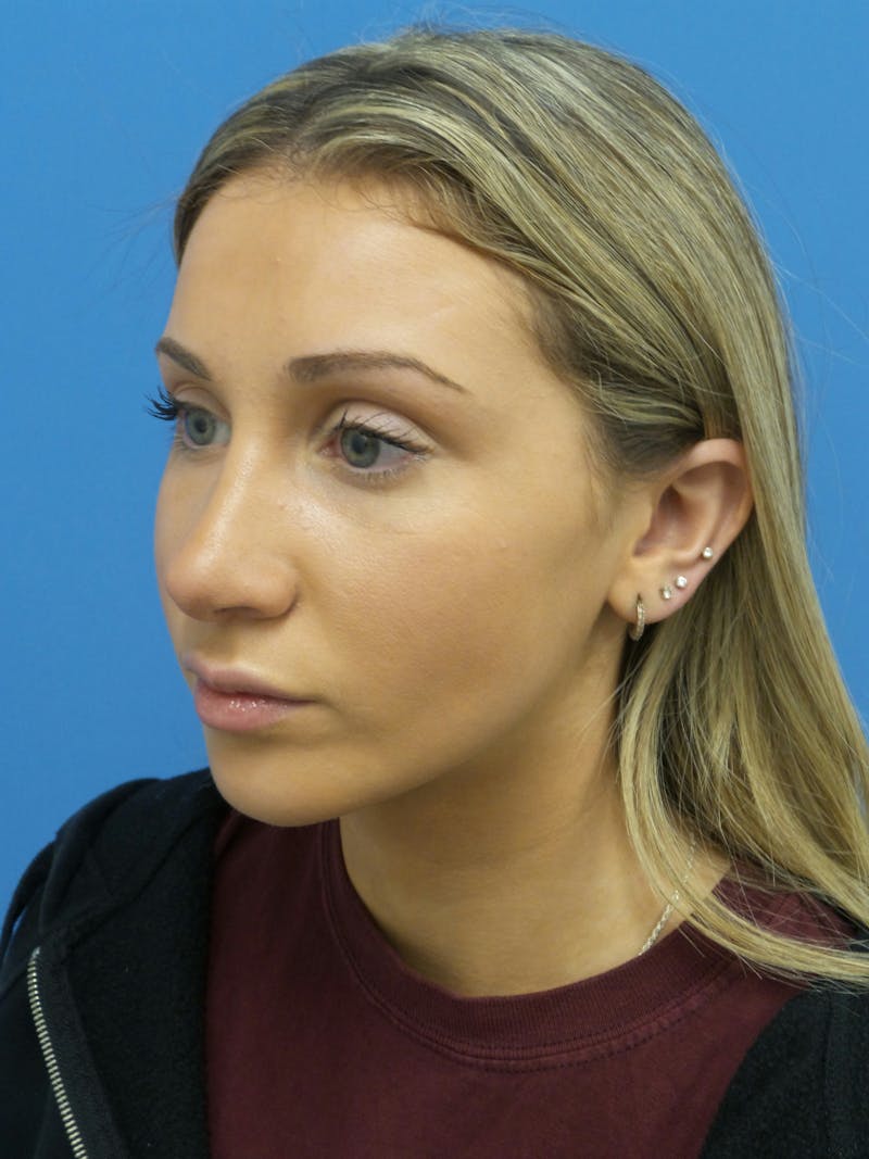 Rhinoplasty Before & After Gallery - Patient 630550 - Image 4