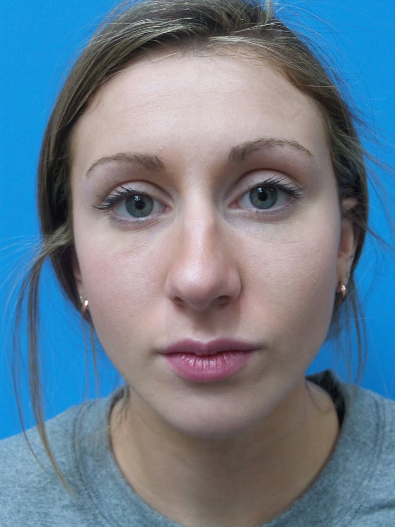 Rhinoplasty Before & After Gallery - Patient 630550 - Image 5