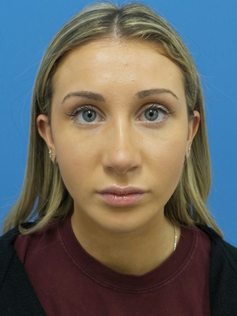 Rhinoplasty Before & After Gallery - Patient 630550 - Image 6